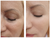 JoliPro IPL Photofacial Laser Home Device Results