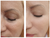 JoliPro IPL Photofacial Laser Home Device Results