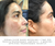 Melanin Ampoule - Melasma & Hyperpigmentation Treatment results
