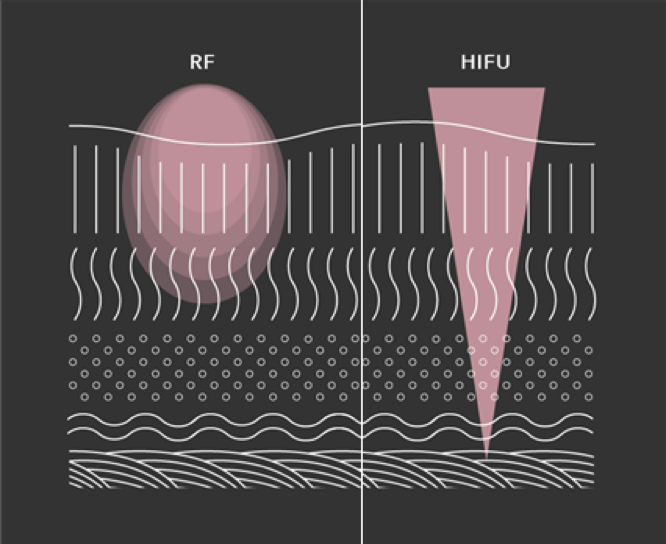RF RADIOFREQUENCY VS. HIFU Joli Visage Store