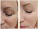 JoliPro IPL Photofacial Laser Home Device