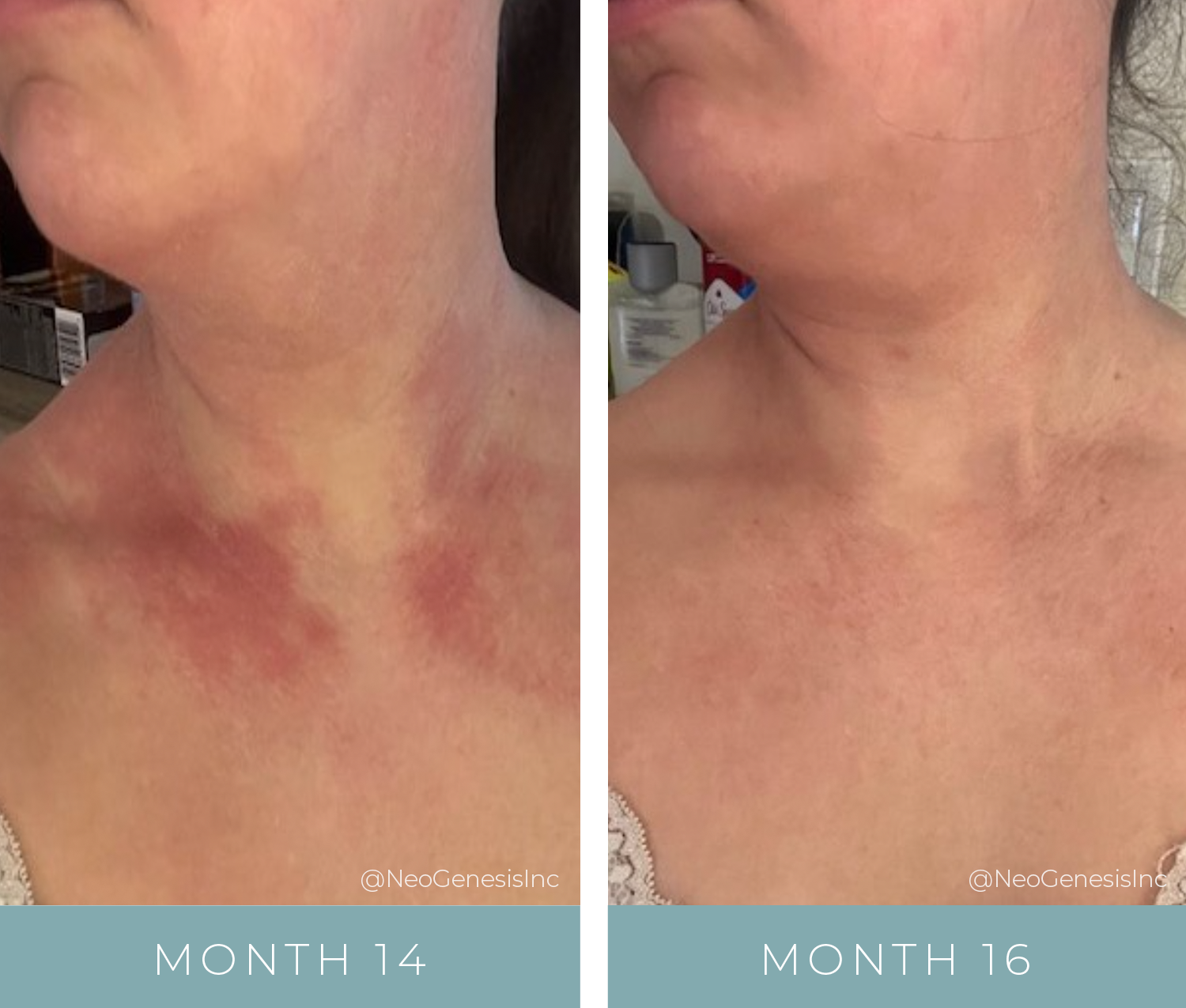 Neogenesis Skin Serum - Before and After results
