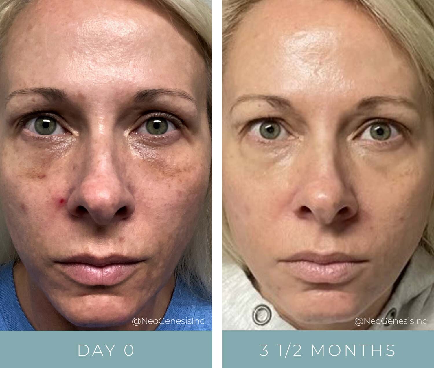 Neogenesis Booster Advanced Renewal Serum Results - Before and After
