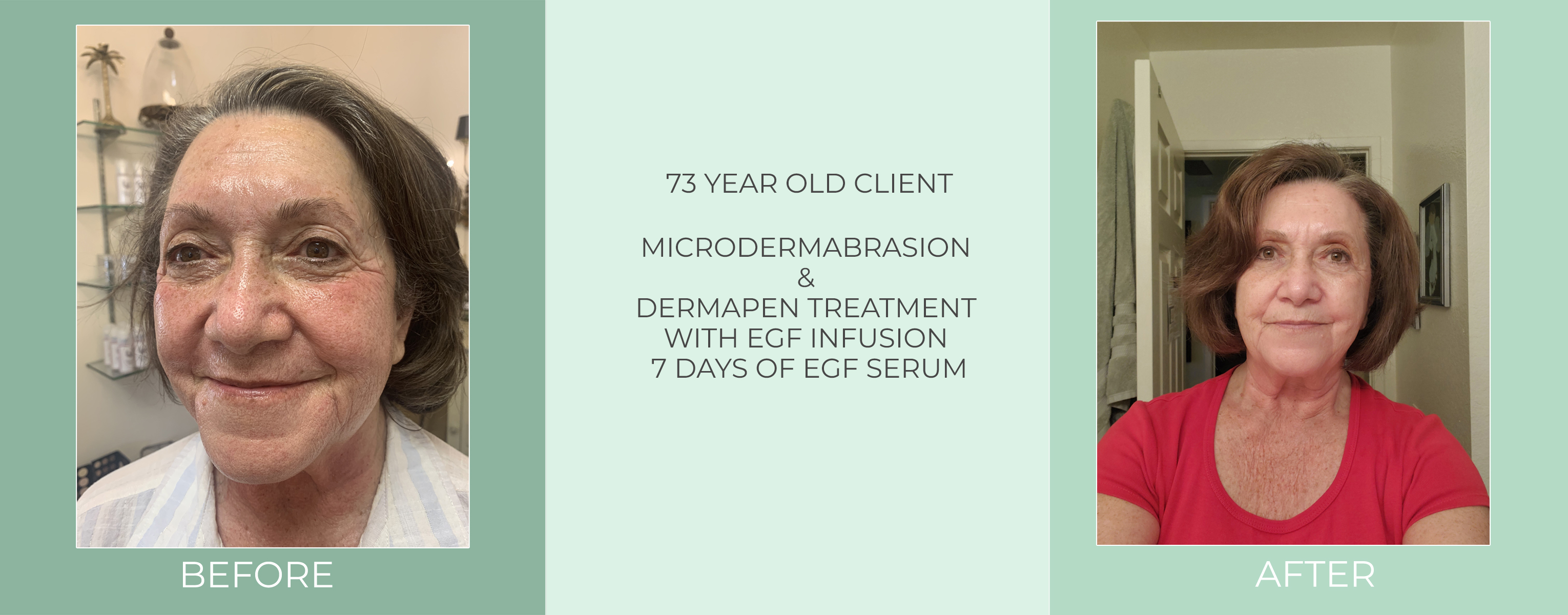 73-year-old-client-microdermabrasion-dermapen-treatment-with-egf-infusion-7-days-of-egf-serum-before-and-after.jpg