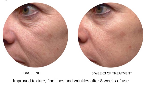 deep-wrinkle-before-and-after-1.jpg