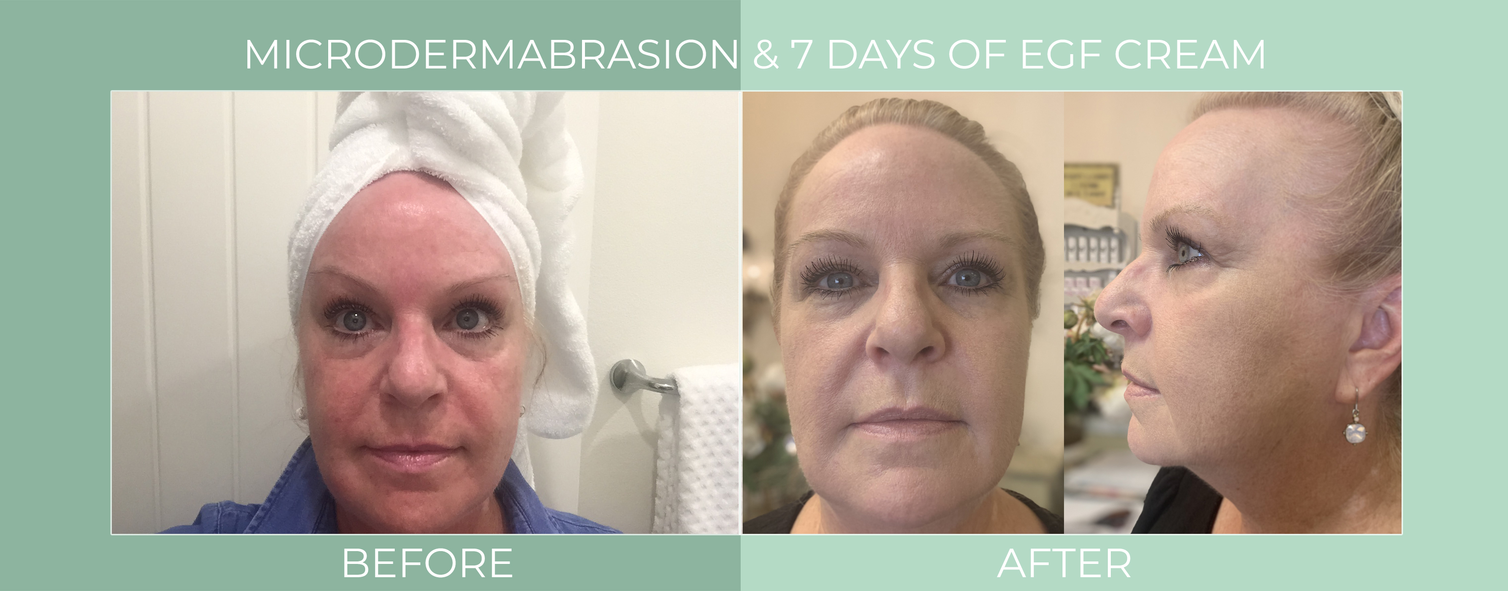 microdermabrasion-7-days-of-egf-cream-before-and-after.jpg