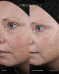 Ultra LumiBright Brightening Peel 60ml