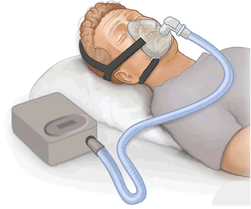 A man with a nasal mask and CPAP machine