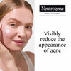 Neutrogena Rapid Clear Stubborn Acne Spot Gel - 1 oz Thumbnail Image