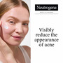 Neutrogena Rapid Clear Stubborn Acne Spot Gel - 1 oz