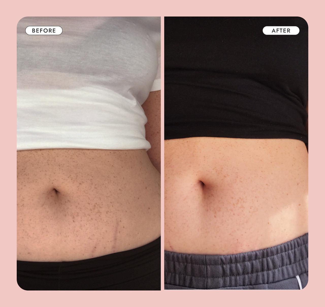 Cream for tummy before and after