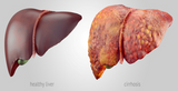 Detoxifying Your Liver Could Help You Lose Between 10-30 Pounds