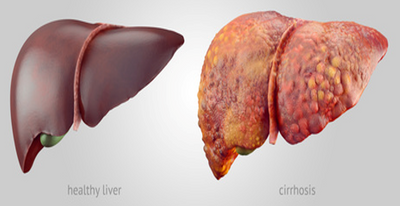 Detoxifying Your Liver Could Help You Lose Between 10-30 Pounds