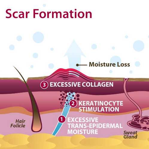 Biodermis Epi-Derm Silicone Natural Gel Sheeting - Standard Sheet