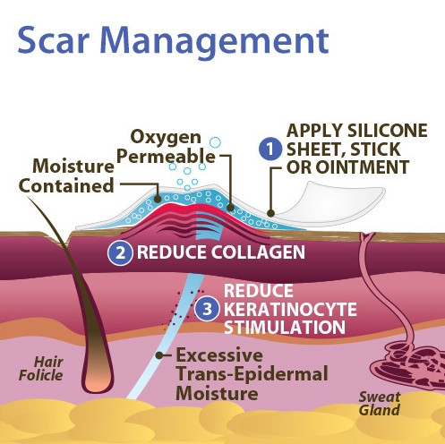 Biodermis Epi-Derm Silicone Natural Gel Sheeting - Standard Sheet