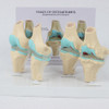 Kit De Joelho: Modelo De Anatomia De Osteoartrite Com Chave 1