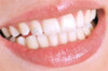 Colocacion Joyeria Dental  Crystales A Domicilio O Gabinete 0 Colocacion Joyeria Dental  Crystales A Domicilio O Gabinete 0