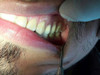 Polimero Blando *alto Brillo* Prótesis Flexible 1kg Dental 2