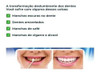 Kit 2 Unidades Branqueador Dental Dentes Sem Manchas Limpeza 5