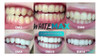 3 Branqueador De Dentes Preço 2019 Artistas 3