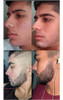 Tratamiento Caída Del Cabello. Loción Capilar + Biotina 3