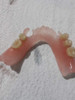 Protesis Flexibles 3