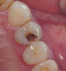 Arreglo De Caries. Once 1
