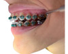 Instalación De Brackets Metálicos - Ortodoncia Metálica 0