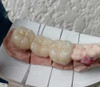 Perno Corona 2