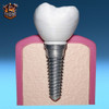 Modelo Molar -implante Dental- Para Estudio Odontológico 1
