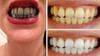 Carbón Activado Blanquear Dientes 200 Grs + Envió 2
