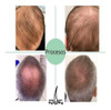 Tratamiento Para Crecimiento Del Cabello - Barba 4 Tratamiento Para Crecimiento Del Cabello - Barba 4