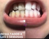 Hismile V34 Pasta De Dientes Blanqueadora 7