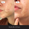Acne Patch Hero Cosmetics Mighty Patch Surface Xl Hydrocollo 4