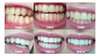 1 Clareamento Dental Whitemax Consultorio Original 7