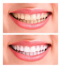 2 Clareador Dentario Clarear Dentes Artistas 7 2 Clareador Dentario Clarear Dentes Artistas 7