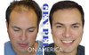 Tratamiento Alopecia La Semilla De Pelo Promo Pack X3 3 Tratamiento Alopecia La Semilla De Pelo Promo Pack X3 3