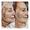Efecto Tensor Antiarrugas Lifting Con Hifu Rostro Completo 1