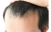 Tratamiento Para Caída De Cabello (mesoterapia) 0