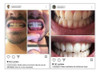 1 Clareador Dental Caseiro Valor 2019 Paulo Zulu 5