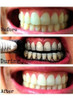Blanqueador Dental Miracle Teeth Carbon Coco Natural No Daña 4