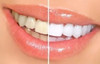Blanqueamiento Dental Con Luz Whitelight Blanqueador 4