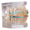 Macro Modelo Porcelana C/ Micro Implantes (ortodoncia) 2