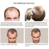 Tratamento De Calvície Cura Cabelo Calvo Freeshipping 2