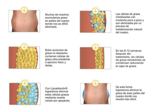 Criolipolisis- Sin Dolor 1