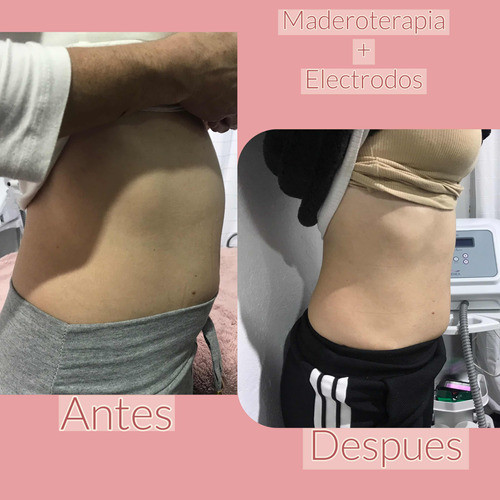 Maderoterapia + Electrodos Cuponera 10 Sesiones 0
