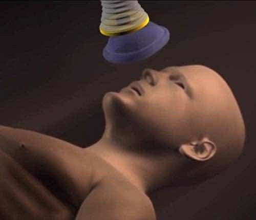 Dispositivo De Resgate Por Asfixia Lifevac 2024 Para Adultos 1