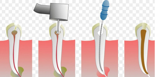 Tratamiento De Conducto Multirradicular Premolares 0