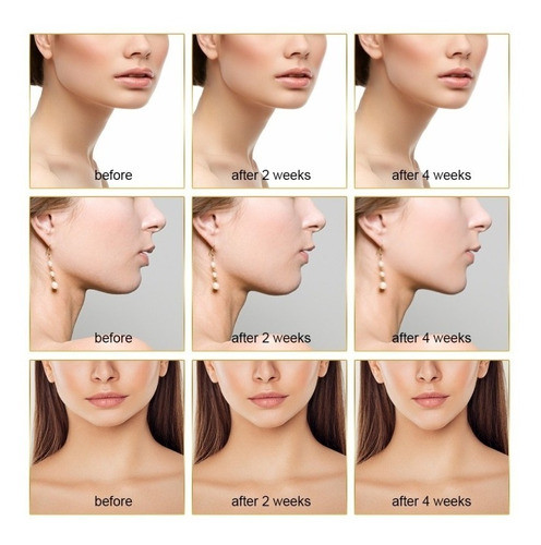 Massageador Facial Levantamento De Pescoço Anti Rugas Papada 1