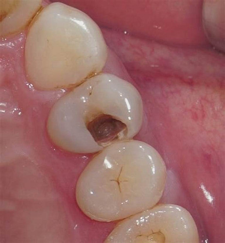 Arreglo De Caries. Once 1